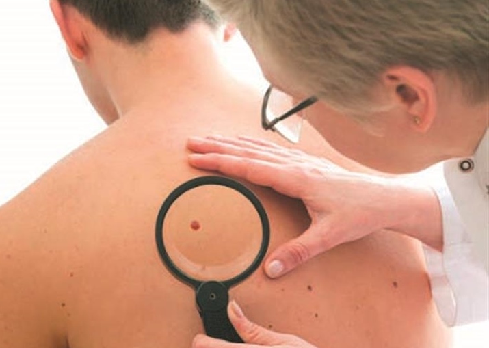 Mais casos de cancro de pele em doentes tratados com picato